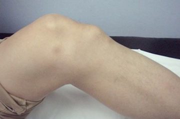 osteokhondropatiya u detejj: mkb 10, klassifikaciya, lechenie, stadii, ehtiologiya i patogenez, prichiny105