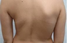 Остеохондроз 3 ступеня шийного, грудного і попереково-крижового відділу хребта: симптоми, лікування