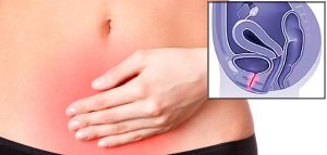 ostryjj uretrit u muzhchin i zhenshhin: prichiny, simptomy, diagnostika, lechenie107