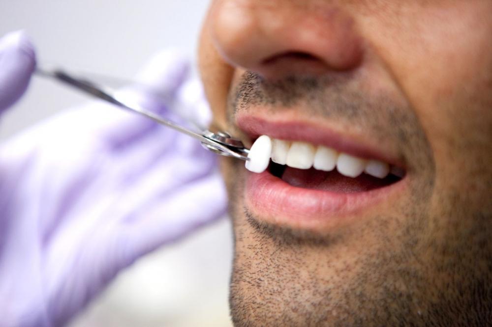 Відбілювання зубів — рекомендації з вибору кращого способу