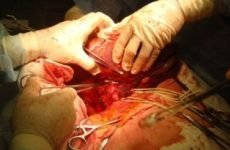 Пересадка печінки: коли проводиться, скільки живуть після операції, наслідки для донора