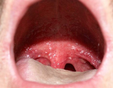 Причини почервоніння слизової оболонки порожнини рота