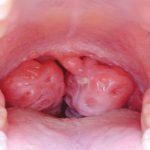 Причини почервоніння слизової оболонки порожнини рота