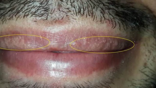 Причини появи білого нальоту на губах у дорослих