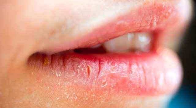 Причини появи білого нальоту на губах у дорослих