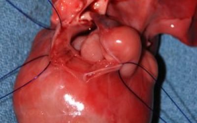 Рабдомиома серця у новонароджених: види, причини, симптоми, лікування