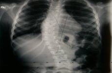 Рентген шийного, грудного, поперекового відділу хребта: як зробити, як підготуватися, що показує, фото