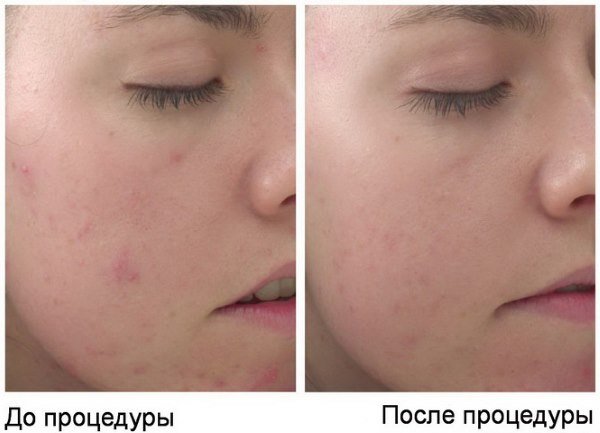 retinoevyjj zheltyjj piling: pokazaniya, protivopokazaniya, tekhnika, oslozhneniya, pobochnye ehffekty, otzyvy, cena186
