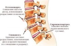 Симптоми остеохондрозу: початкові ознаки, біль в спині і серце, головний біль, задишка, IRR