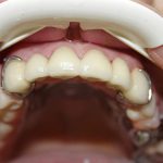 Знімні зубні протези без неба на верхню щелепу