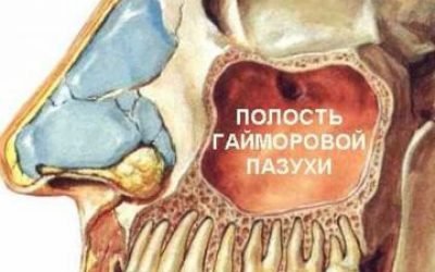 Видалення кісти гайморової пазухи: ендоскопічна операція, відео