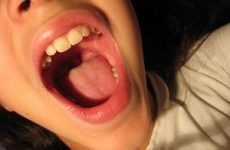 Увулит: симптоми і лікування в домашніх умовах, фото язичка, код за МКХ-10