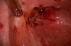 Вузлова міома матки в поєднанні з ендометріозом: ознаки і причини, протипоказання, лікування