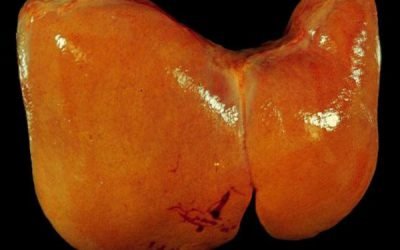 Жировий гепатоз печінки: симптоми, медикаментозне лікування і народними засобами, дієта