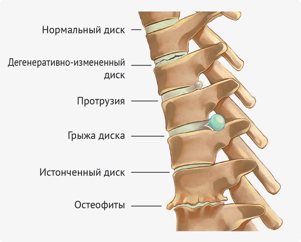 zhzhenie v spine: v oblasti lopatok, szadi, sboku sleva ili sprava, pod rebrami, vnizu153