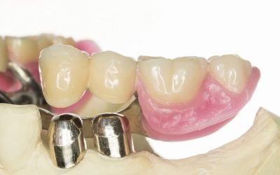 Чим відрізняється нижній знімний зубний протез від верхнього?
