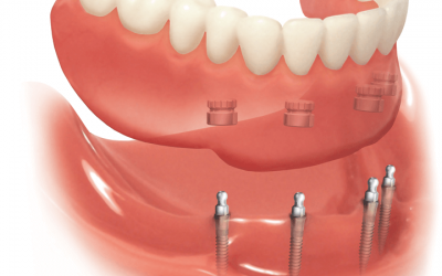 Що являють собою умовно-знімні зубні протези?