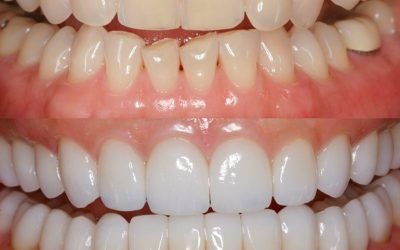 Що таке художня реставрація зубів і в чому її особливість?