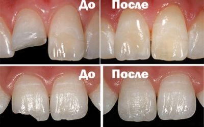 Що таке реставрація зубів?