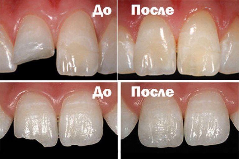 Що таке реставрація зубів?