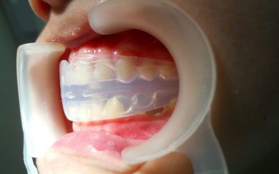Що таке трейнери для зубів і навіщо вони потрібні?