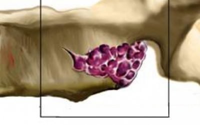 Гемангіома шийного відділу хребта: особливості та лікування