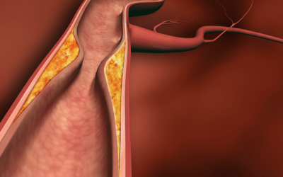 Гігантоклітинним скроневий артеріїт або хвороба Хортона: причини, ознаки і тактика лікування