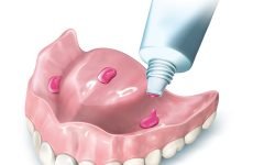 Як відбувається фіксація зубних протезів?