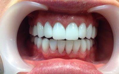 Як відбувається протезування передніх зубів?