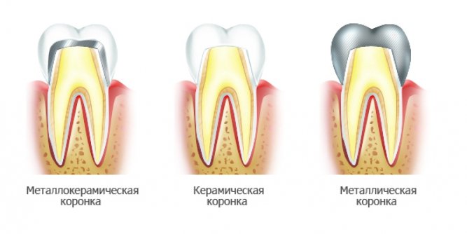 Як проходить протезування зубів коронками?