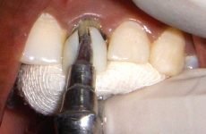 Як знімають коронки з зубів?