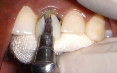 Як знімають коронки з зубів?
