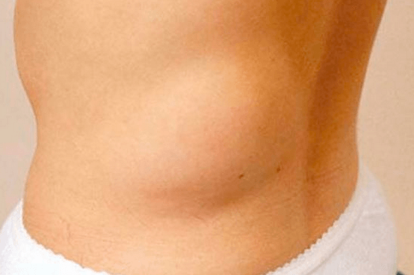 Липома на спине: появление и лечение жировика