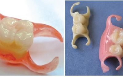 Чи можна встановити знімний протез на один зуб?