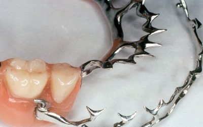 Особливості та застосування в стоматології шинируючих протезів