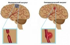 Відмінності симптомів і патогенезу ішемічного та геморагічного інсульту