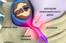 Протрузія шийного відділу хребта: методика лікування