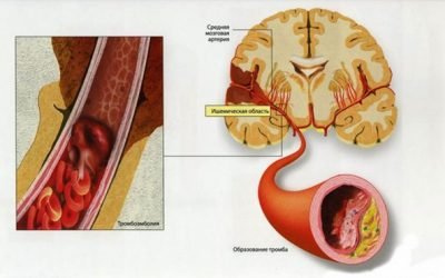 Симптоми та методи лікування тромбозу кавернозного синуса