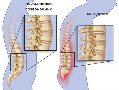 Спондилит поясничного отдела позвоночника: диагностика и лечение