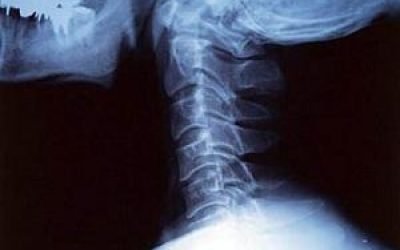 Видалення міжхребцевої грижі шийного відділу хребта