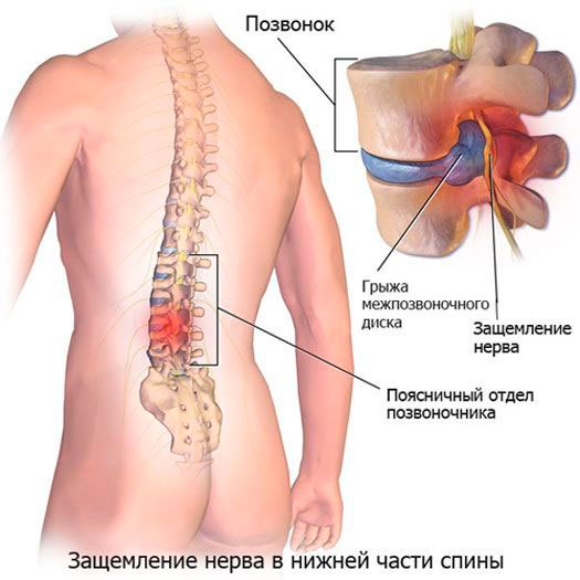 Защемление нерва в позвоночнике: поясничный, шейный, грудной