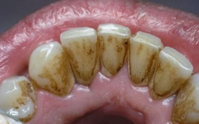 Чим небезпечний зубний камінь і якої шкоди він може завдати?