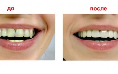 Що собою являє естетична реставрація зубів і коли її призначають?