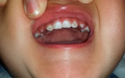 Що таке гіпоплазія емалі зубів у дітей і як її лікувати?