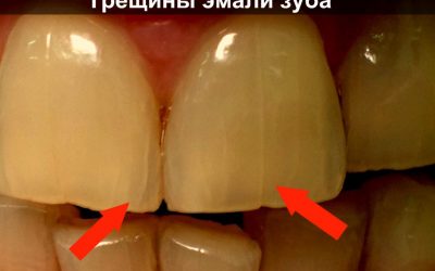Як швидко і просто відновити зубну емаль в домашніх умовах?