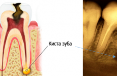 Як лікувати кісту зуба без операції?