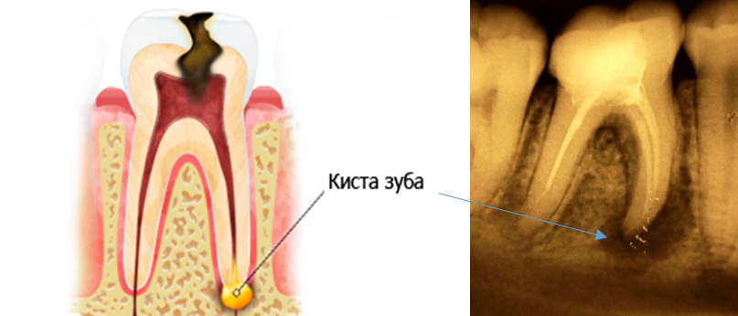 kak lechit kistu zuba bez operacii 162