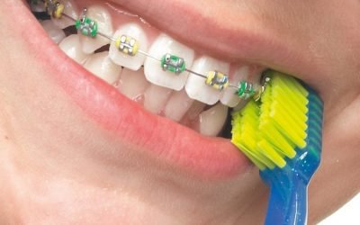 Як правильно чистити зуби з брекетами, щоб не псувалися ні зуби, ні системи?