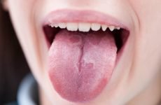 Як провести лікування глоситу мови в домашніх умовах?