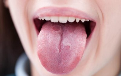 Як провести лікування глоситу мови в домашніх умовах?
